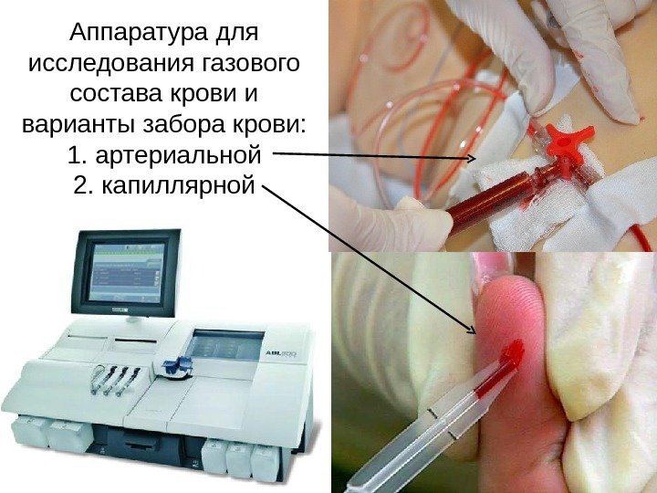 Аппаратура для исследования газового состава крови и варианты забора крови: 1. артериальной 2. капиллярной