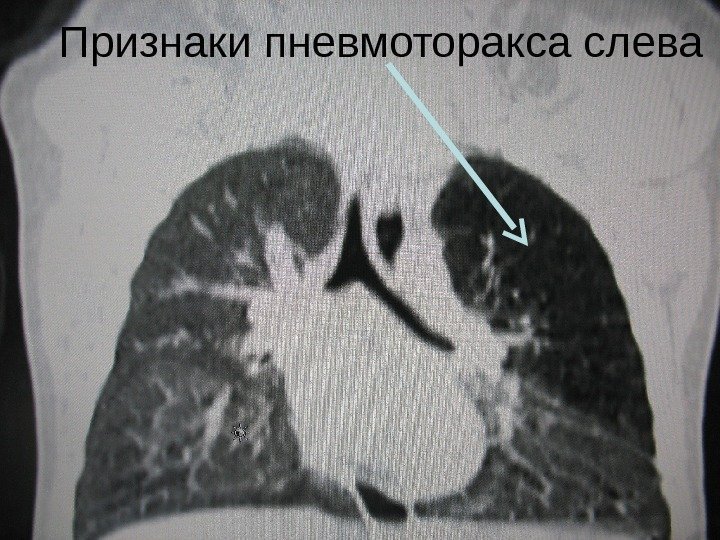 Признаки пневмоторакса слева 