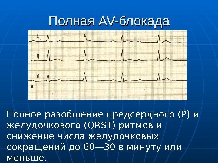 Полная AV-AV- блокада Полное разобщение предсердного (Р) и желудочкового ( QRST ) ритмов и