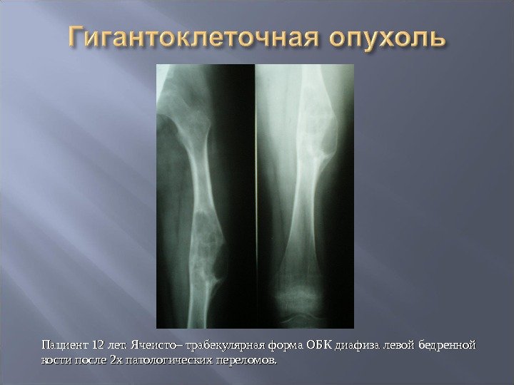 Пациент 12 лет. Ячеисто– трабекулярная форма ОБК диафиза левой бедренной кости после 2 х
