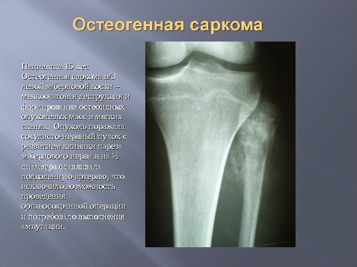 Пациентка 15 лет.  Остеогенная саркома в/3 левой м/берцовой кости – мелкоочаговая деструкция и