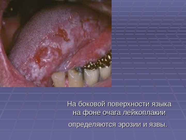   На боковой поверхности языка на фоне очага лейкоплакии определяются эрозии и язвы.