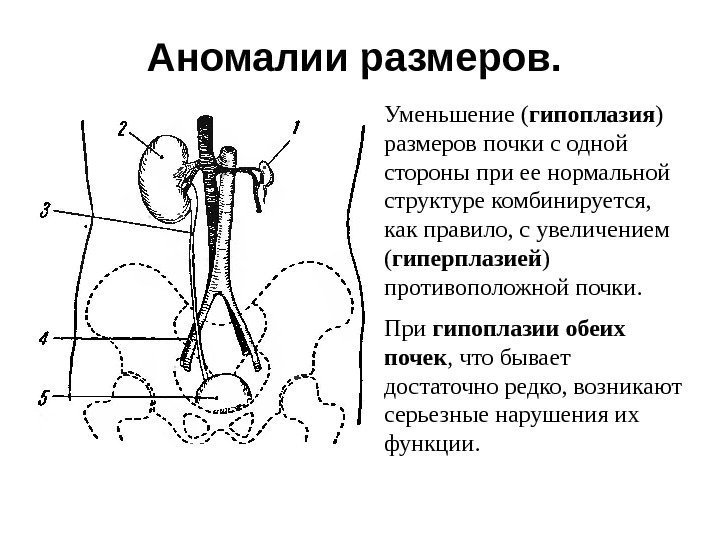 Аномалии размеров.  Уменьшение ( гипоплазия ) размеров почки с одной стороны при ее