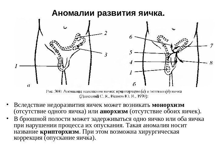 Аномалии развития яичка. • Вследствие недоразвития яичек может возникать монорхизм (отсутствие одного яичка) или