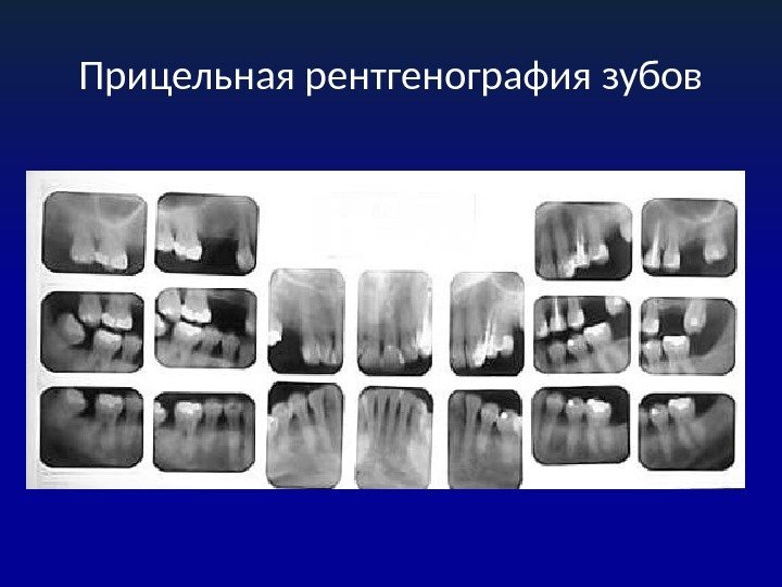Прицельная рентгенография зубов 