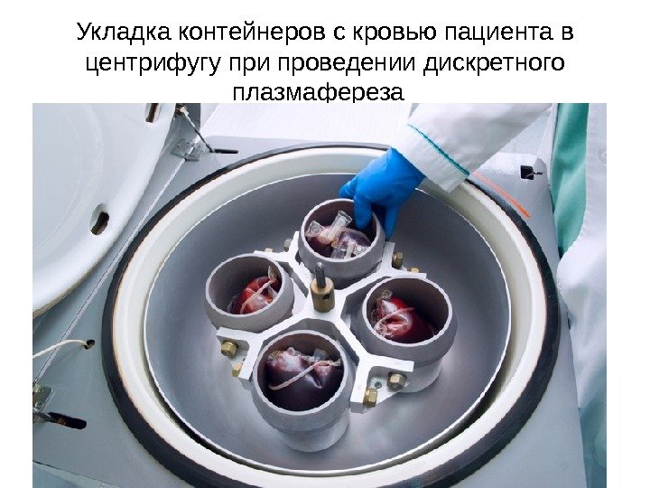 Укладка контейнеров с кровью пациента в центрифугу при проведении дискретного плазмафереза  