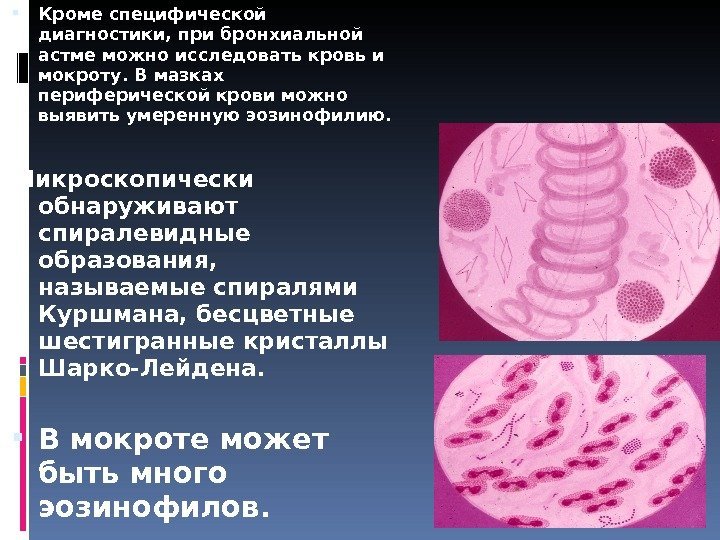 Мокрота при бронхиальной астме. Бронхиальная астма анализ мокроты спирали Куршмана. Бронхиальная астма эозинофилия. Эозинофмлы про бронхиальной асме. Эозинофилия крови при бронхиальной астме.