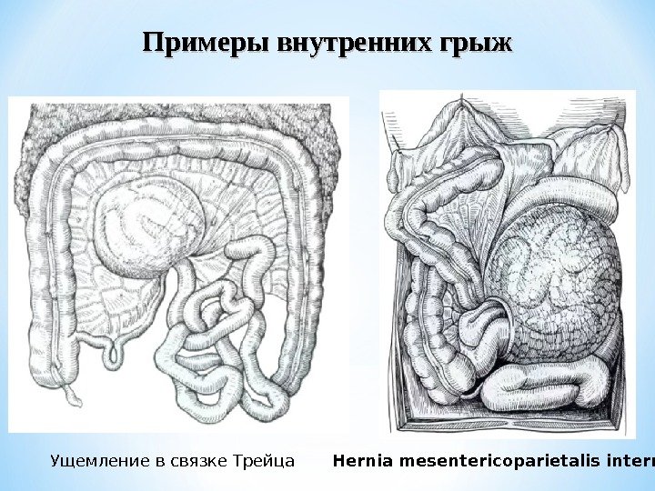 Ущемление в связке Трейца Hernia mesentericoparietalis interna Примеры внутренних грыж 