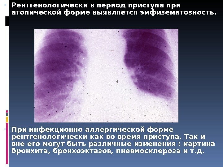  Рентгенологически в период приступа при атопической форме выявляется эмфизематозность.  При инфекционно аллергической
