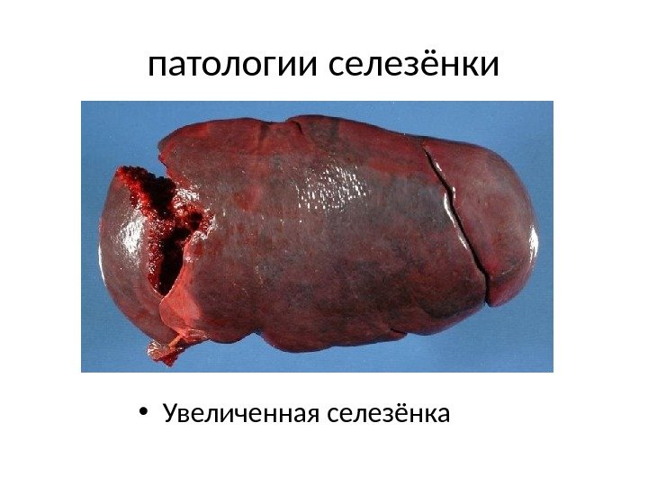 патологии селезёнки • Увеличенная селезёнка 