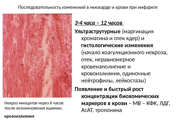 Последовательность изменений в миокарде и крови при инфаркте 3 -4 часа – 12 часов