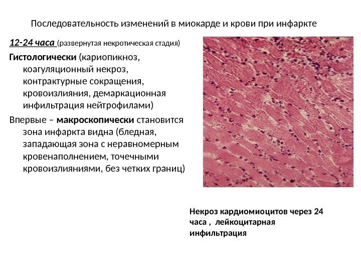 Последовательность изменений в миокарде и крови при инфаркте Некроз кардиомиоцитов через 24 часа ,