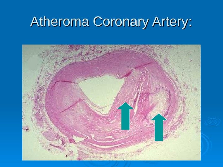 Atheroma Coronary Artery:  