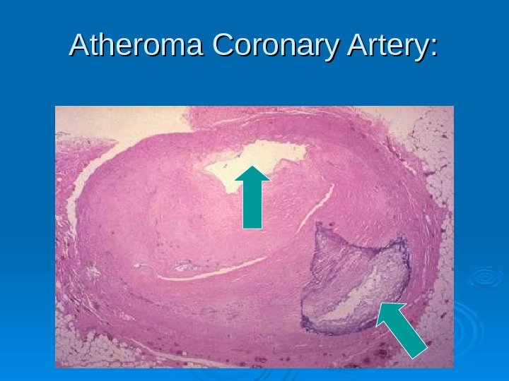 Atheroma Coronary Artery:  