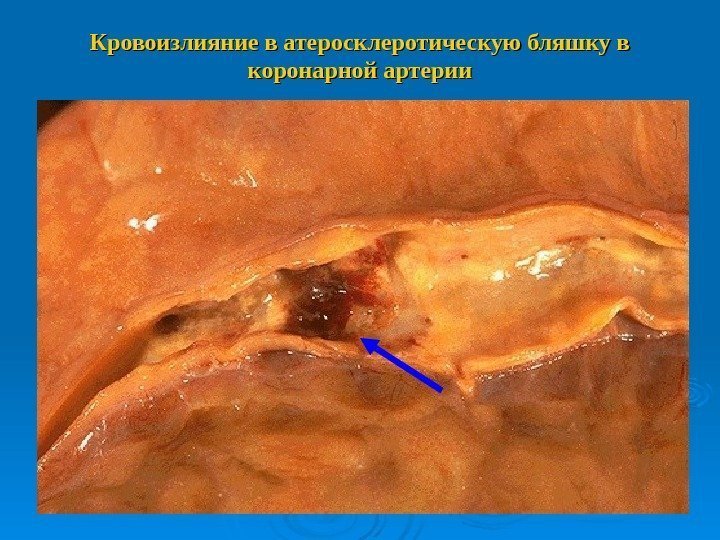 Кровоизлияние в атеросклеротическую бляшку в коронарной артерии 