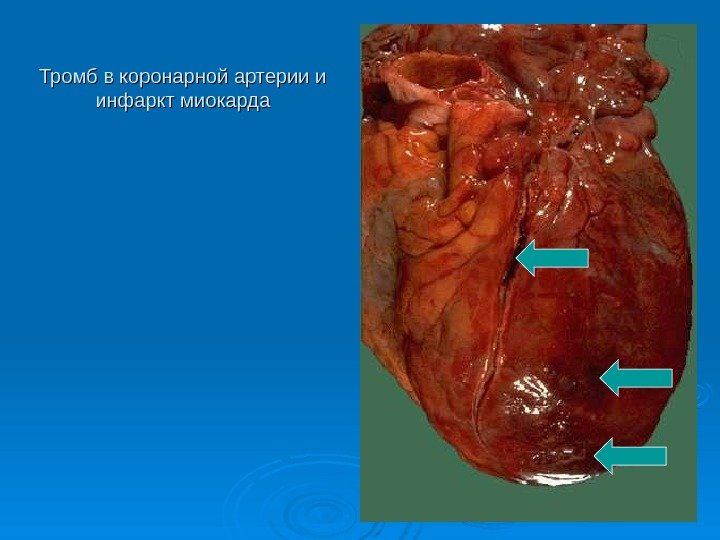 Тромб в коронарной артерии и инфаркт миокарда 