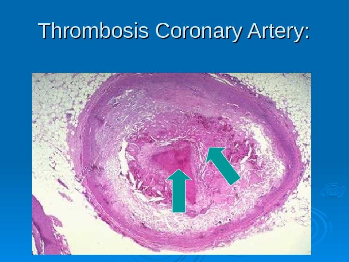 Thrombosis Coronary Artery:  