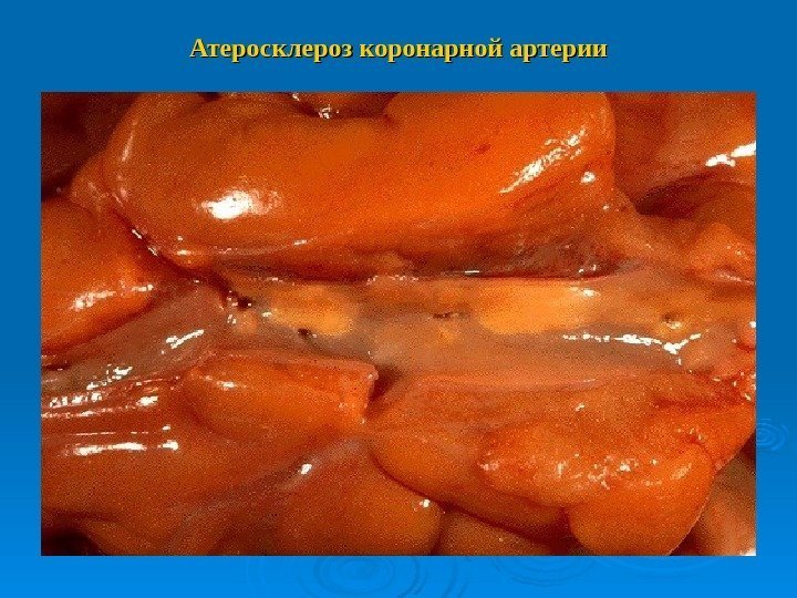 Атеросклероз коронарной артерии 