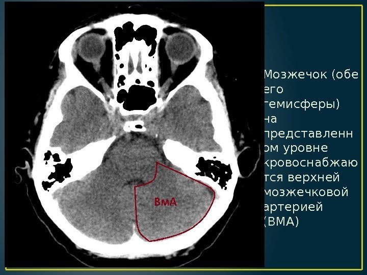 Мозжечок (обе его гемисферы) на представленн ом уровне кровоснабжаю тся верхней мозжечковой артерией (ВМА)