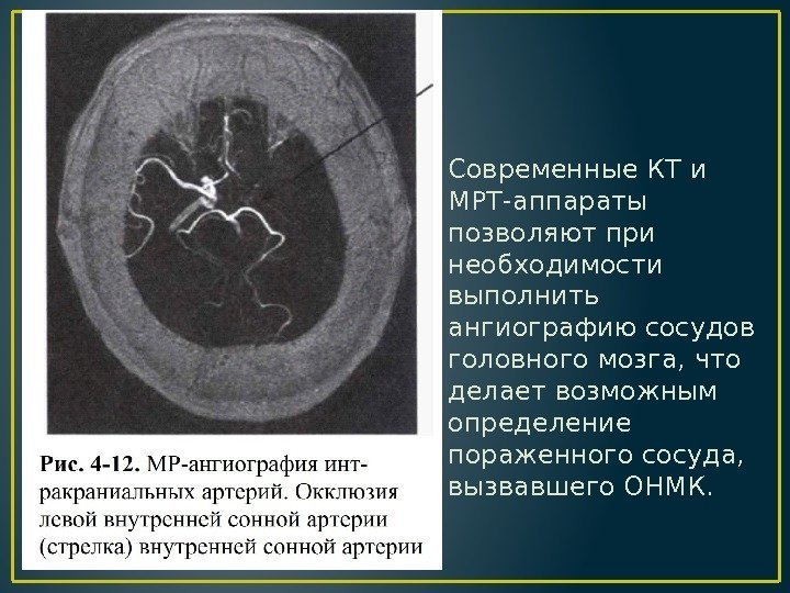Современные КТ и МРТ-аппараты позволяют при необходимости выполнить ангиографию сосудов головного мозга, что делает
