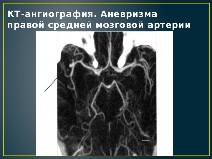 КТ-ангиография. Аневризма правой средней мозговой артерии 