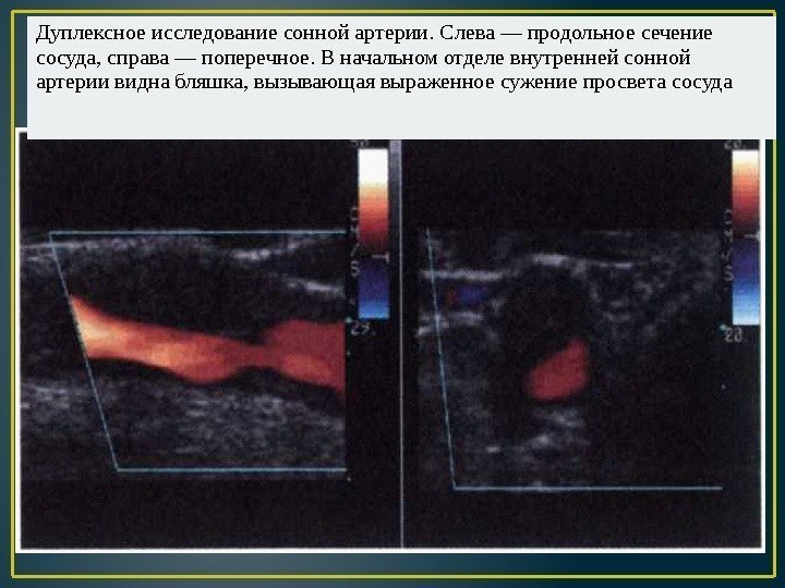 Дуплексное исследование сонной артерии. Слева — продольное сечение сосуда, справа — поперечное. В начальном