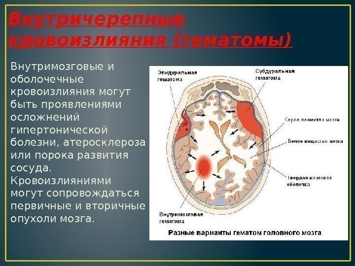 Кровоизлияние в полушарие. Внутримозговое субкортикальное кровоизлияние. Внутричерепное кровоизлияние. Типы кровоизлияний в головном мозге. Гематомы мозга классификация.