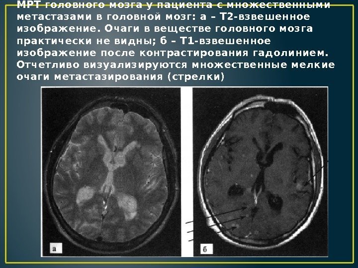МРТ головного мозга у пациента с множественными метастазами в головной мозг: а – Т