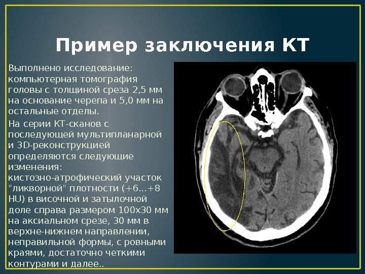 Пример заключения КТ Выполнено исследование:  компьютерная томография головы с толщиной среза 2, 5