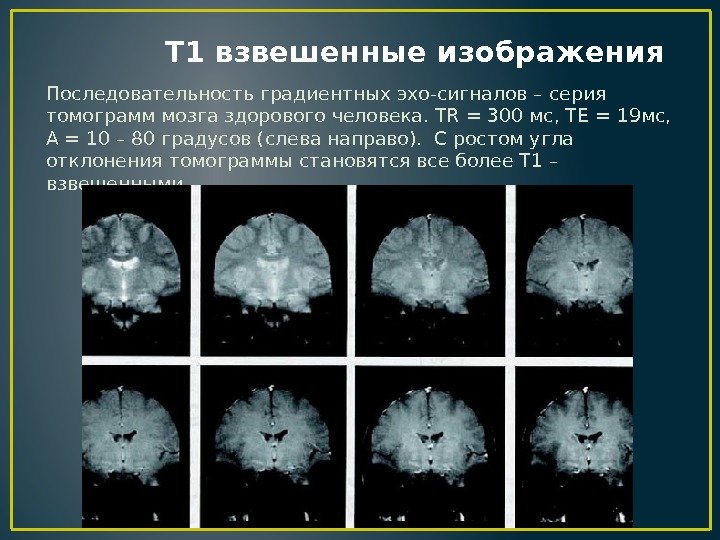  T 1 взвешенные изображения Последовательность градиентных эхо-сигналов – серия томограмм мозга здорового