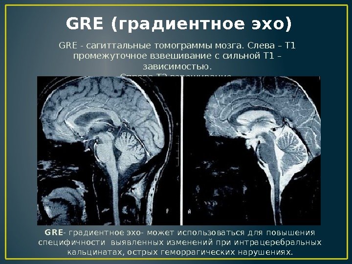  GRE (градиентное эхо) GRE - сагиттальные томограммы мозга. Слева – Т 1 промежуточное