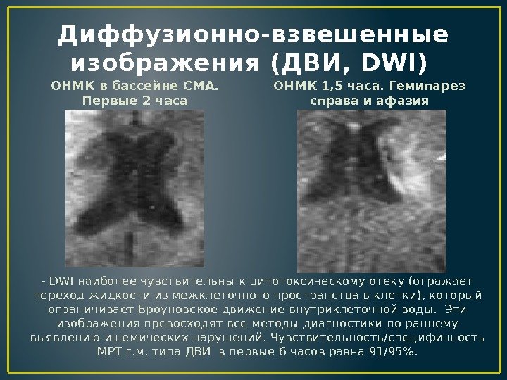 Диффузионно-взвешенные изображения (ДВИ, DWI) ОНМК в бассейне СМА.  Первые 2 часа - DWI