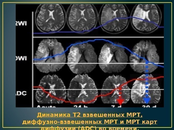 Динамика Т 2 взвешенных МРТ,  диффузно-взвешенных МРТ и МРТ карт диффузии (ADC) во