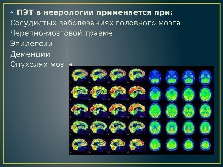  • ПЭТ в неврологии применяется при: Сосудистых заболеваниях головного мозга Черепно-мозговой травме Эпилепсии
