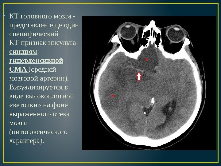  • КТ головного мозга - представлен еще один специфический КТ-признак инсульта – синдром