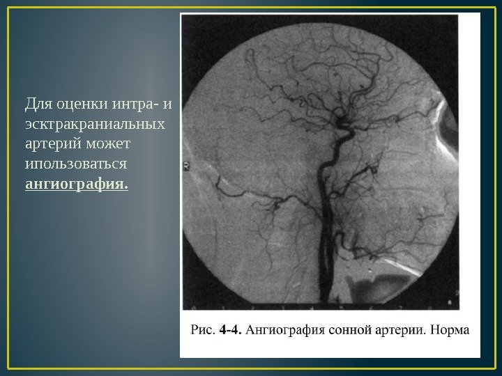 Для оценки интра- и эсктракраниальных артерий может ипользоваться ангиография. 