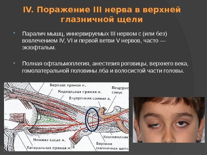 IV. Поражение III нерва в верхней глазничной щели Паралич мышц, иннервируемых III нервом с