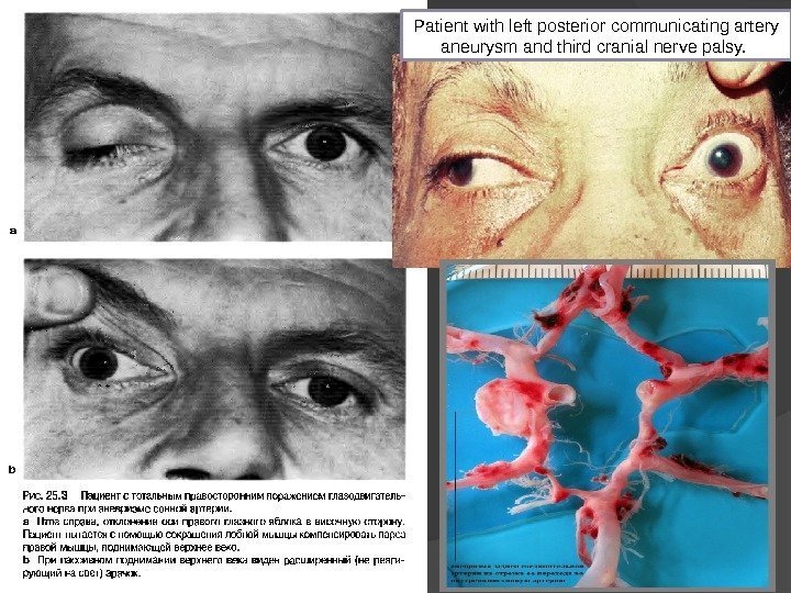 Patient with left posterior communicating artery aneurysm and third cranial nerve palsy.  
