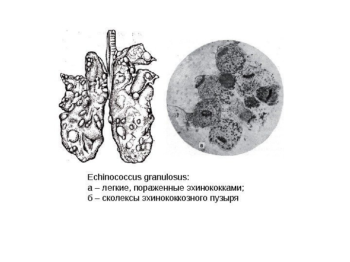 Echinococcus granulosus: а – легкие, пораженные эхинококками; б – сколексы эхинококкозного пузыря 