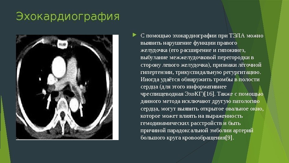 Эхокардиография С помощью эхокардиографии при ТЭЛА можно выявить нарушение функции правого желудочка (его расширение