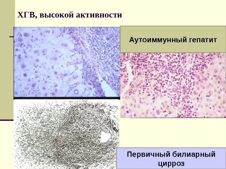 ХГВ, высокой активности Аутоиммунный гепатит Первичный билиарный цирроз 