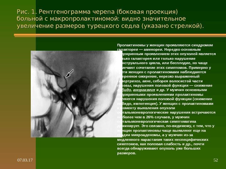 07. 03. 17 52 Рис. 1. Рентгенограмма черепа (боковая проекция) больной с макропролактиномой: видно