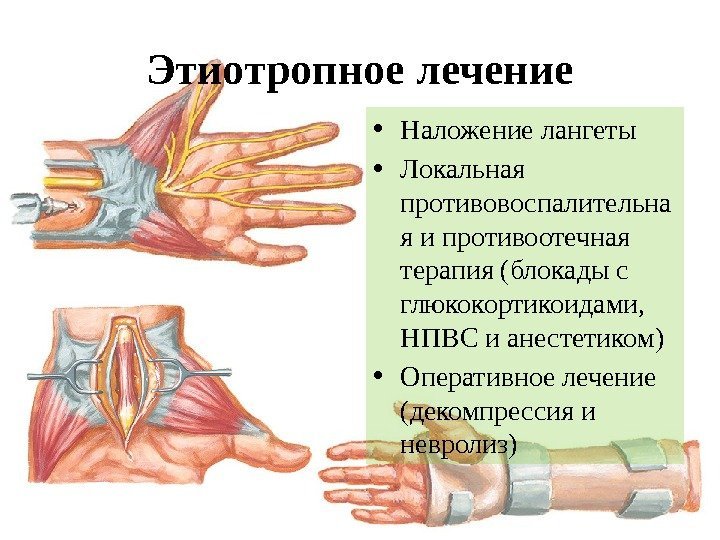 Мононевропатия это