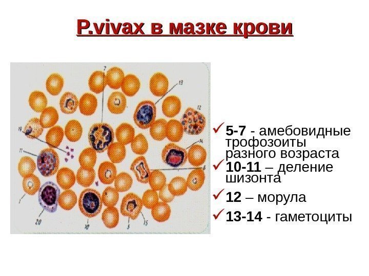   P. vivax в мазке крови 5 -7 - амебовидные трофозоиты разного возраста