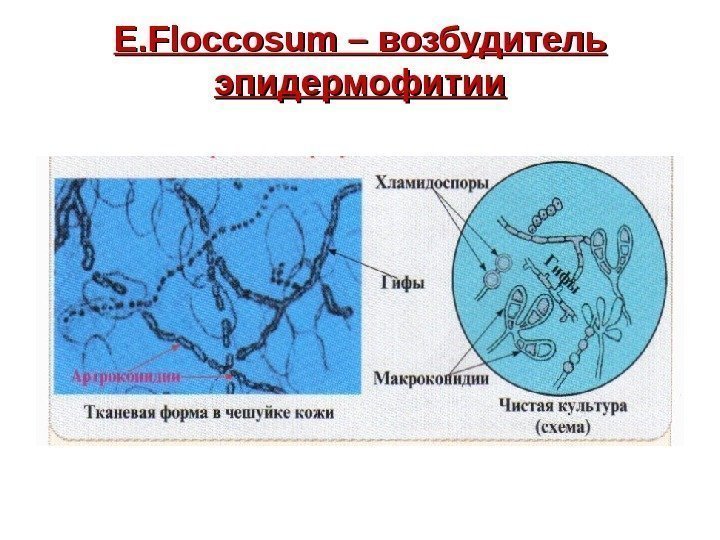   E. Floccosum – возбудитель эпидермофитии 