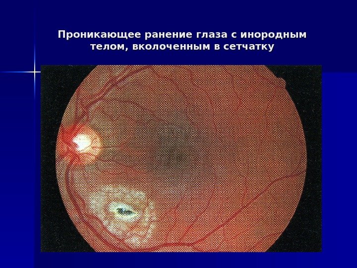   Проникающее ранение глаза с инородным телом, вколоченным в сетчатку 