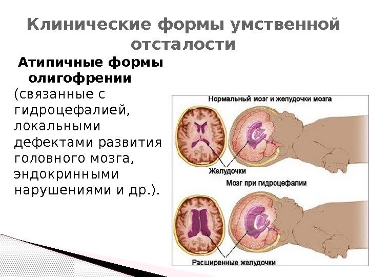 Атипичные формы олигофрении (связанные с гидроцефалией,  локальными дефектами развития головного мозга,  эндокринными