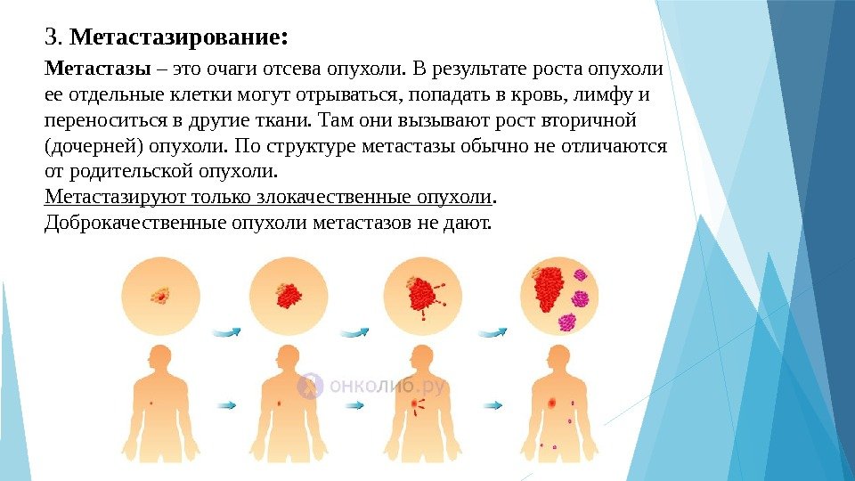 Метастазы –этоочагиотсеваопухоли. Врезультатеростаопухоли ееотдельныеклеткимогутотрываться, попадатьвкровь, лимфуи переноситьсявдругиеткани. Тамонивызываютроствторичной (дочерней)опухоли. Поструктуреметастазыобычнонеотличаются отродительскойопухоли. Метастазируюттолькозлокачественныеопухоли. Доброкачественныеопухолиметастазовнедают. 3.
