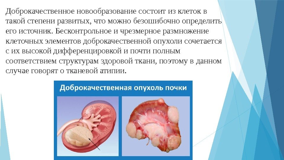 Доброкачественноеновообразованиесостоитизклетокв такойстепениразвитых, чтоможнобезошибочноопределить егоисточник. Бесконтрольноеичрезмерноеразмножение клеточныхэлементовдоброкачественнойопухолисочетается сихвысокойдифференцировкойипочтиполным соответствиемструктурамздоровойткани, поэтомувданном случаеговорятотканевойатипии.    