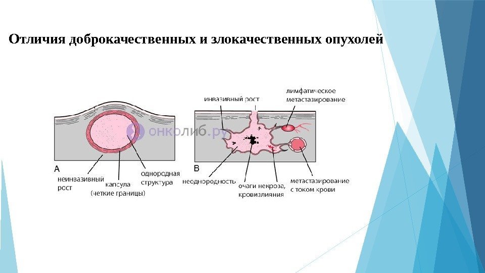 Картинки злокачественные и доброкачественные опухоли